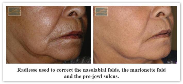 Radiesse New Orleans LA - Dr Mary Lupo