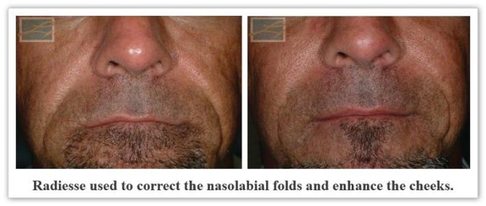 Radiesse Before & After New Orleans LA - Dr Mary Lupo