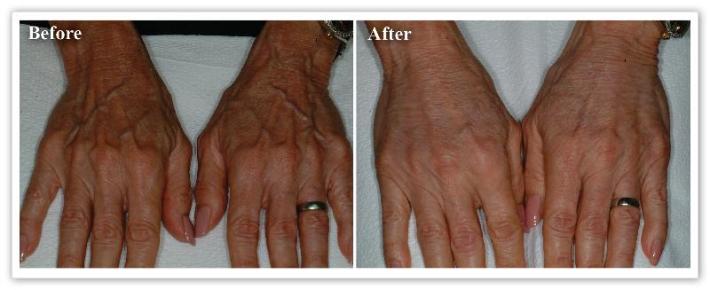 Radiesse Treatment  New Orleans LA - Dr Mary Lupo