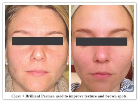 Clear + Brilliant New Orleans LA - Dr Mary Lupo