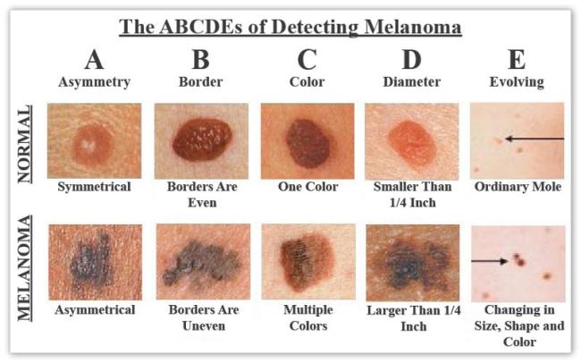 Melanoma New Orleans LA - Dr Mary Lupo