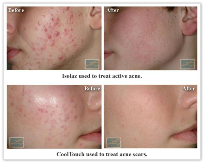 Acne New Orleans La- Dr Mary Lupo