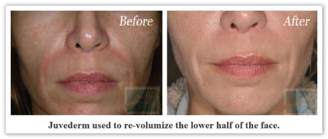 Juvederm New Orleans LA - Dr Mary Lupo