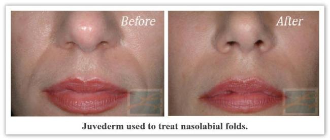 Juvederm New Orleans LA - Dr Mary Lupo
