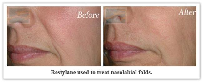 Restylane New Orleans LA - Dr Mary Lupo