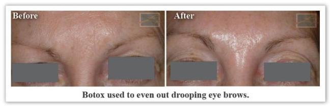 Botox New Orleans LA Dr Mary Lupo