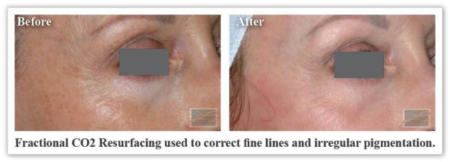 Fractional CO2 Resurfacing New Orleans LA Dr Mary Lupo