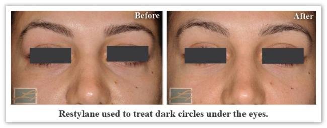 Restylane New Orleans LA Dr Mary Lupo