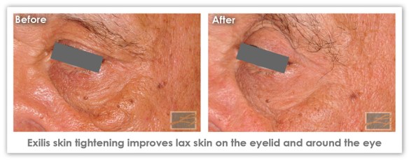 blog-8-28-2015-exilis