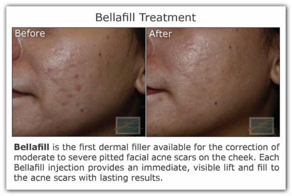 Dr. Lupo_Bellafill treatment_11-18-15