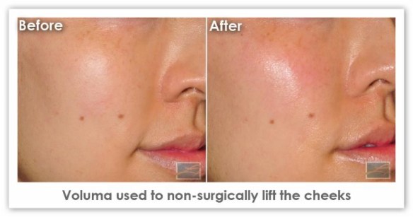 Dr. Lupo_Juvederm_2-8-16