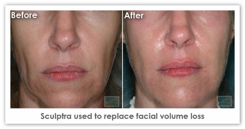 Dr. Lupo_Sculptra_2-8-16