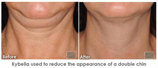 Lose Double Chin and Smooth Wrinkles with Double Savings.