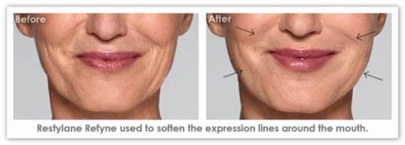 restylane-before-after1