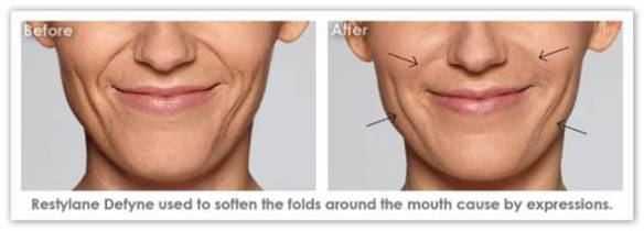 restylane-before-after2