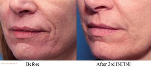 Lupo Infini Before and After