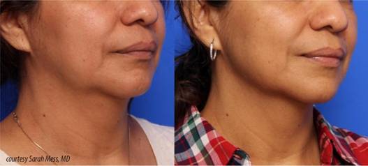 Before and After Inifin Procedure Dr Lupo