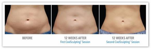 CoolSculpting for Fat Reduction - Before After Results 4