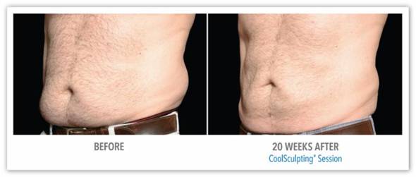 CoolSculpting for Fat Reduction - Before After Results 1