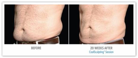 CoolSculpting for Fat Reduction - Before After Results 1