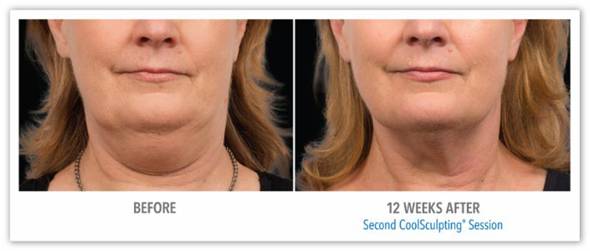 CoolSculpting for Fat Reduction - Before After Results 2