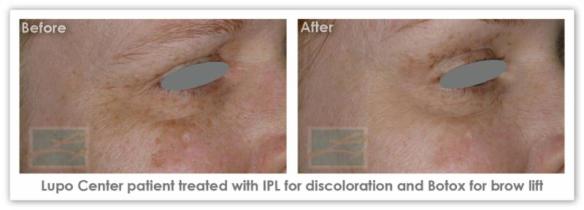 IPL Skin Rejuvenation  - Before After Results 1