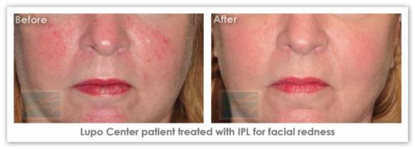 IPL Skin Rejuvenation  - Before After Results 2