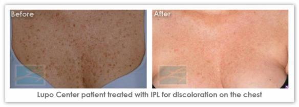 IPL Skin Rejuvenation  - Before After Results 3