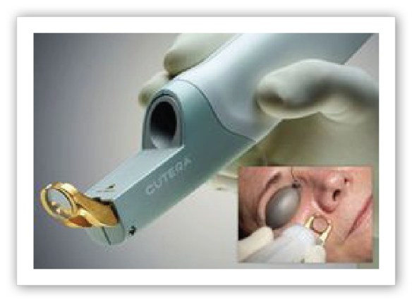 Summer Sun Damage with IPL Skin Rejuvenation