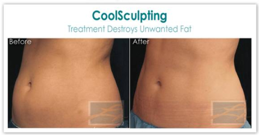 coolsculpting Before and After