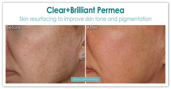 ClearBrilliant Permea before and after