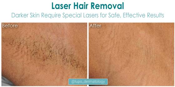 Laser Hair Removal