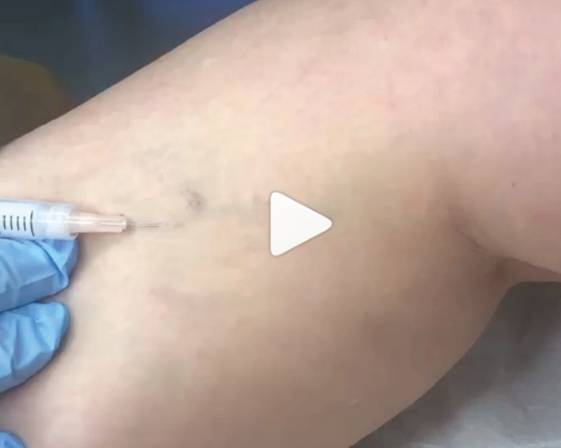 Sclerotherapy is an injectable treatment that gets rid of unsightly, superficial reticular and spider veins. When the vein is destroyed, blood is rerouted to other healthier veins without disrupting blood flow.