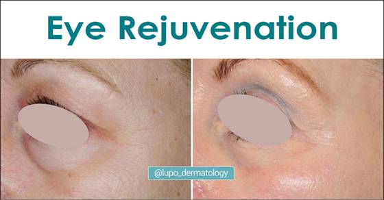 Eye Rejuvenation