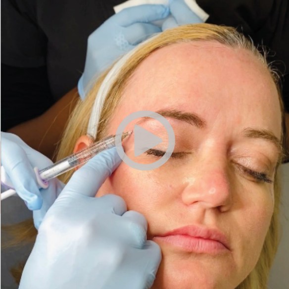 Non-Surgical Brow Lift