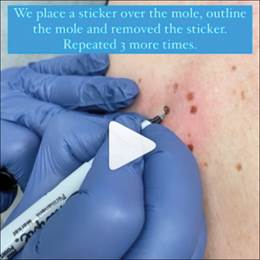 Detect Melanoma with a Sticker!