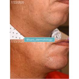 Fillers Before & After Image -1 