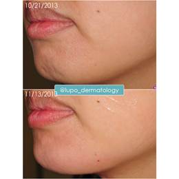 Fillers Before & After Image -2