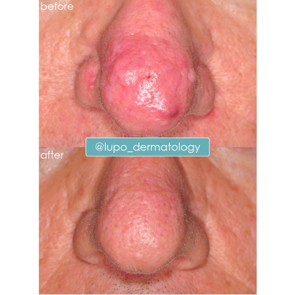 Rosacea Before & After Results