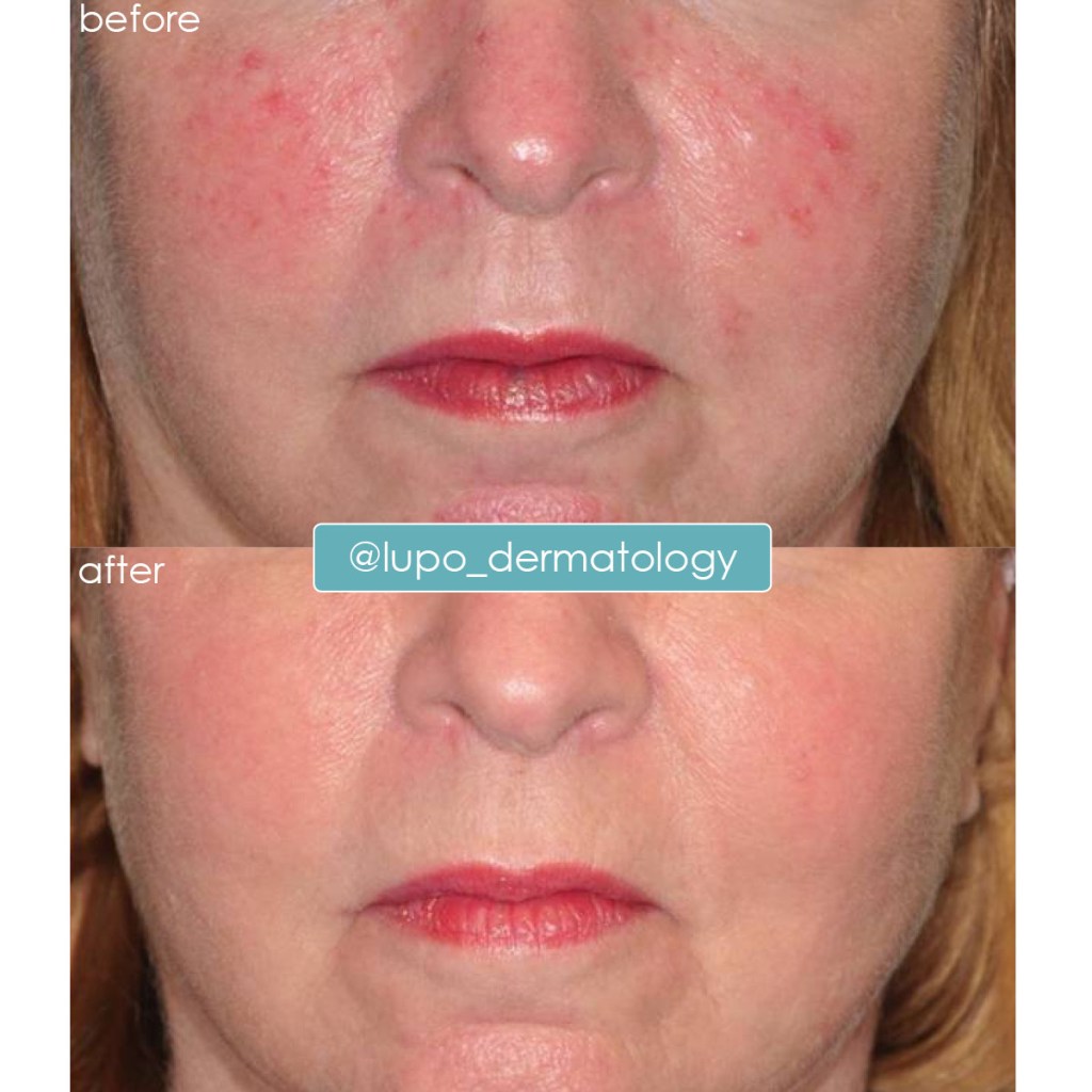 Rosacea Before & After Results