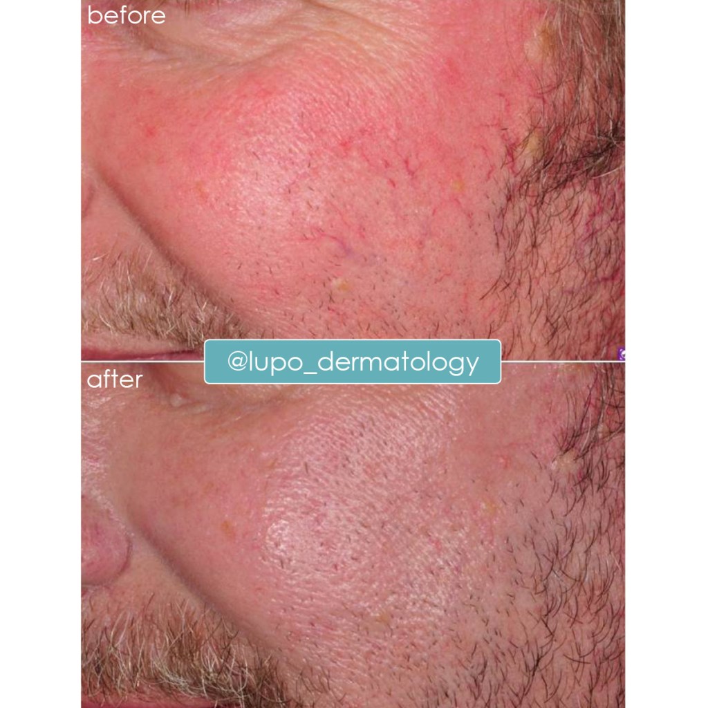 Rosacea Before & After Results