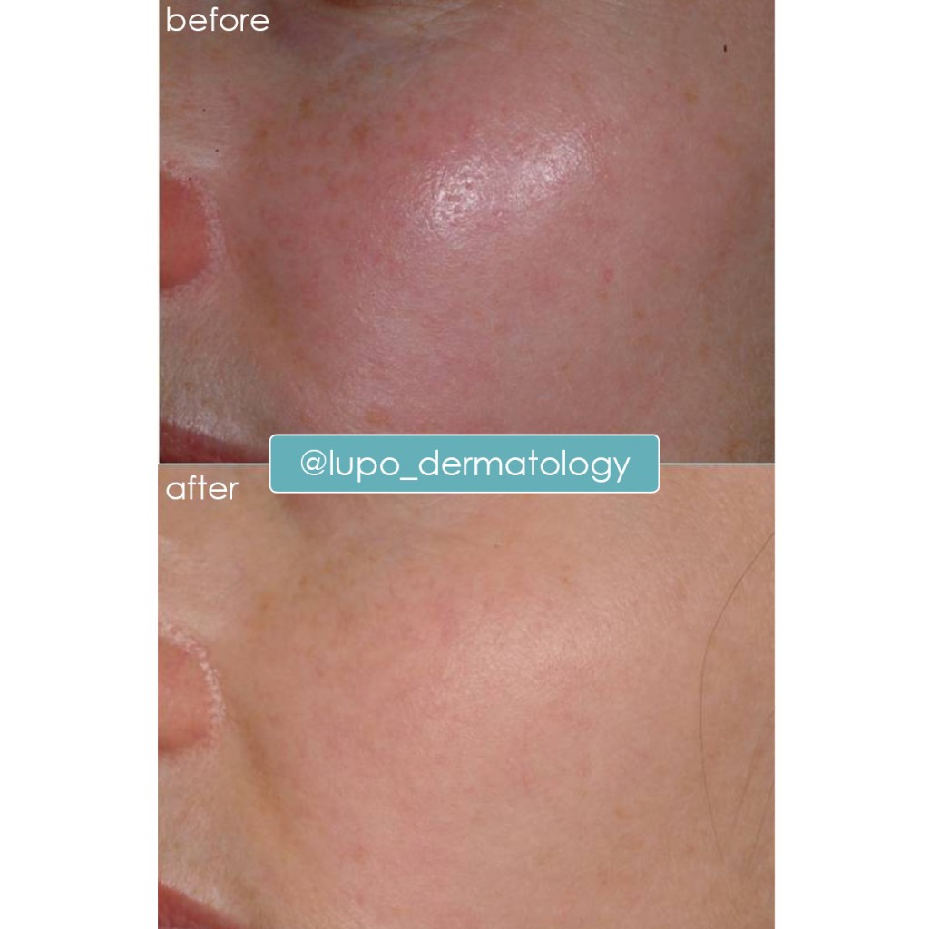 Rosacea Before & After Results