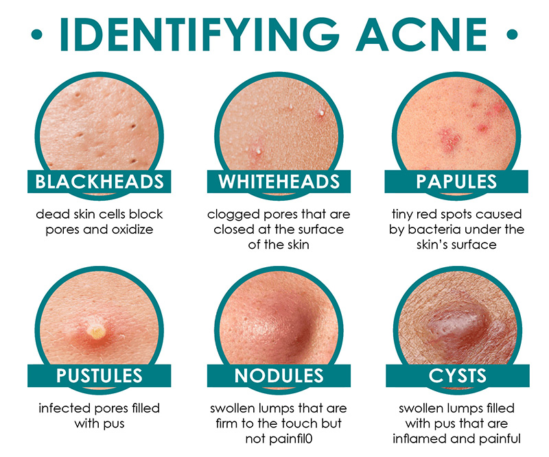 Acne Awareness Month