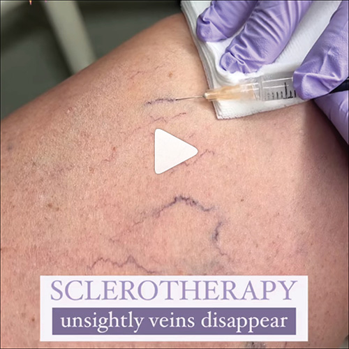 Sclerotherapy injectable treatment