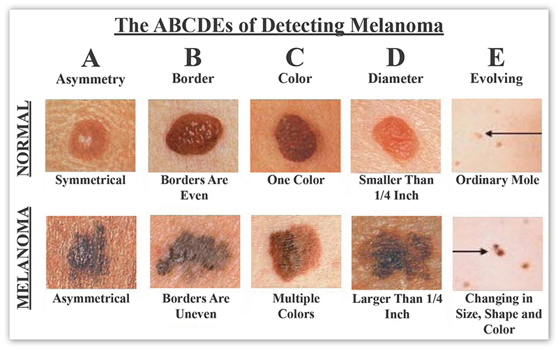 The ABCDEs of Detecting Melanoma