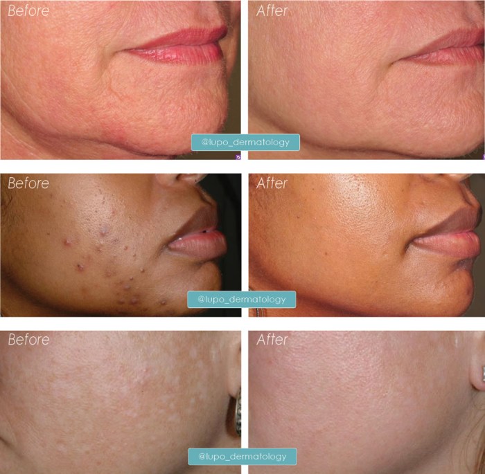 Re+glo Restorative Laser Facial