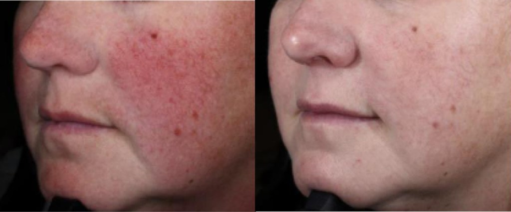 Before and After Image of the Treatement