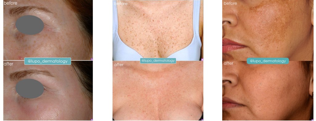 Skin Resurfacing Treatments - Before and After Images