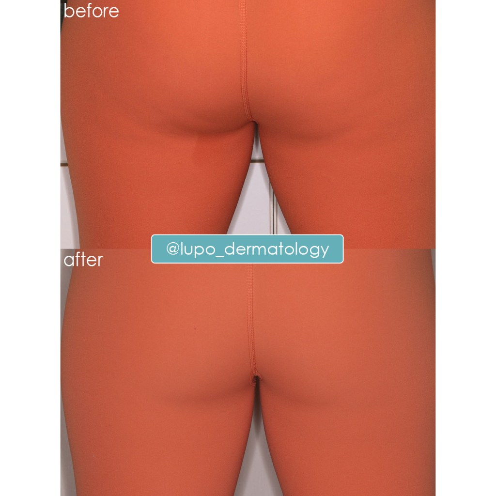 Before and After Images of QWO Treatment Video