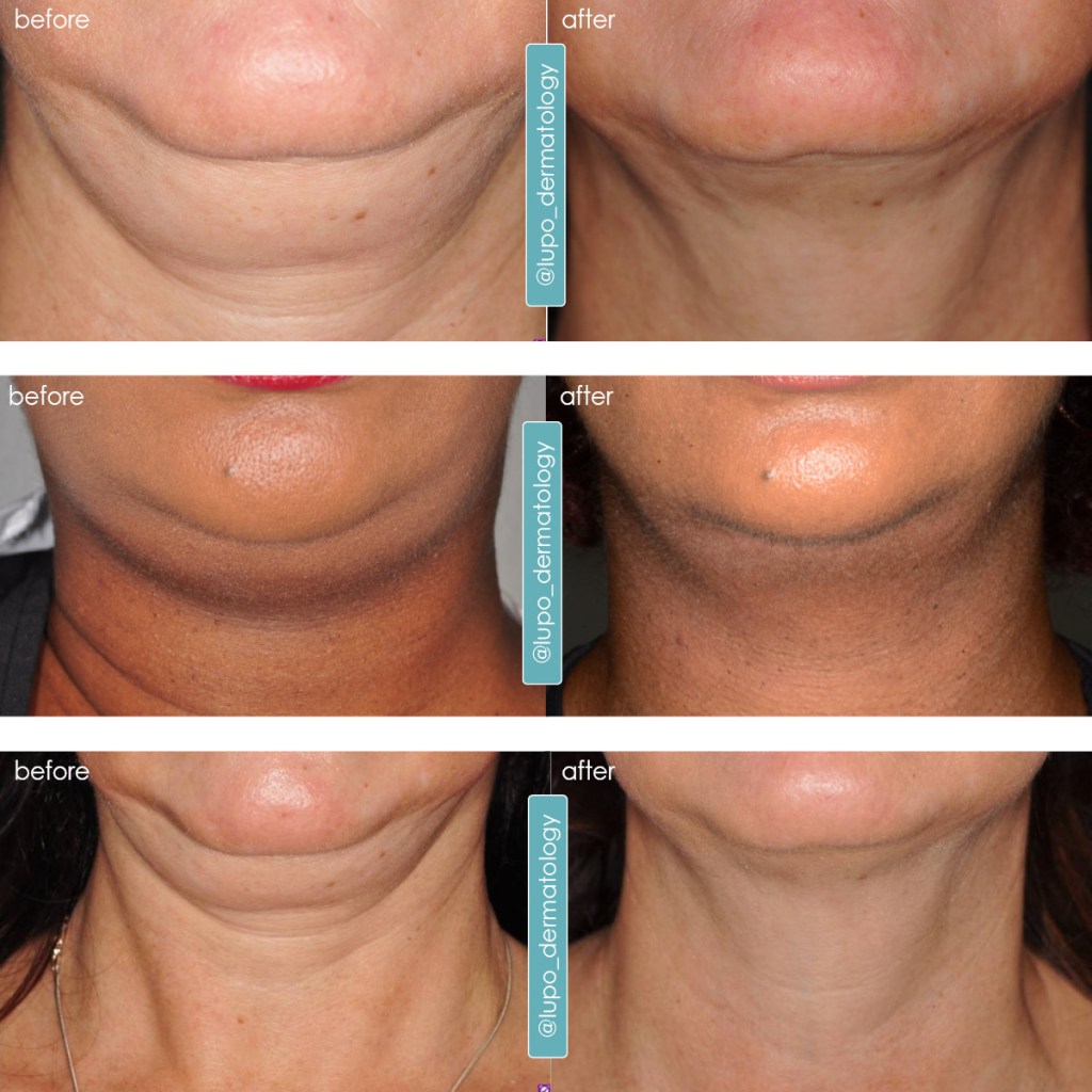 Kybella - Before and After Images -  Dr. Mary Lupo